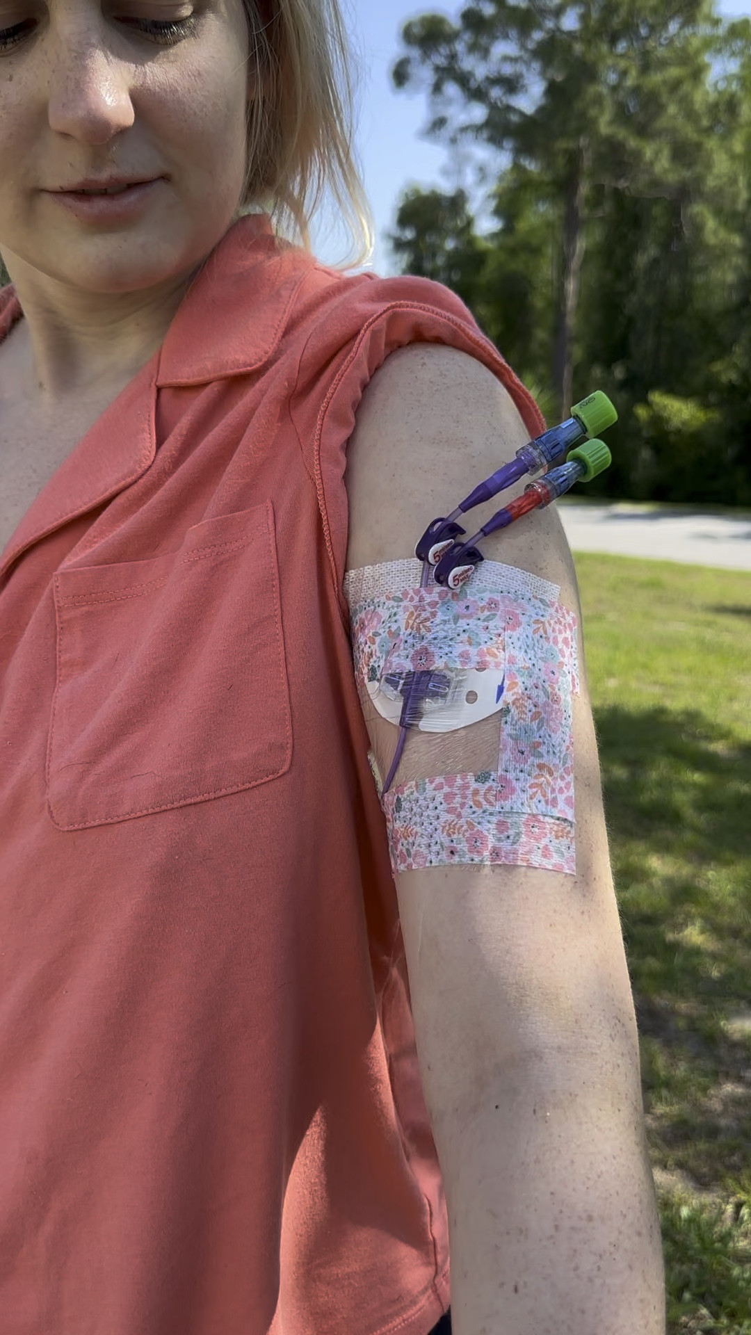 “Tubie Tape” is my new obsession & can be used to secure Picc Lines, Nasal Tubes, Hickmans, and more! This fashionable medical tape is 🙌🏼

#LTKVideo #LTKstyletip #LTKbeauty