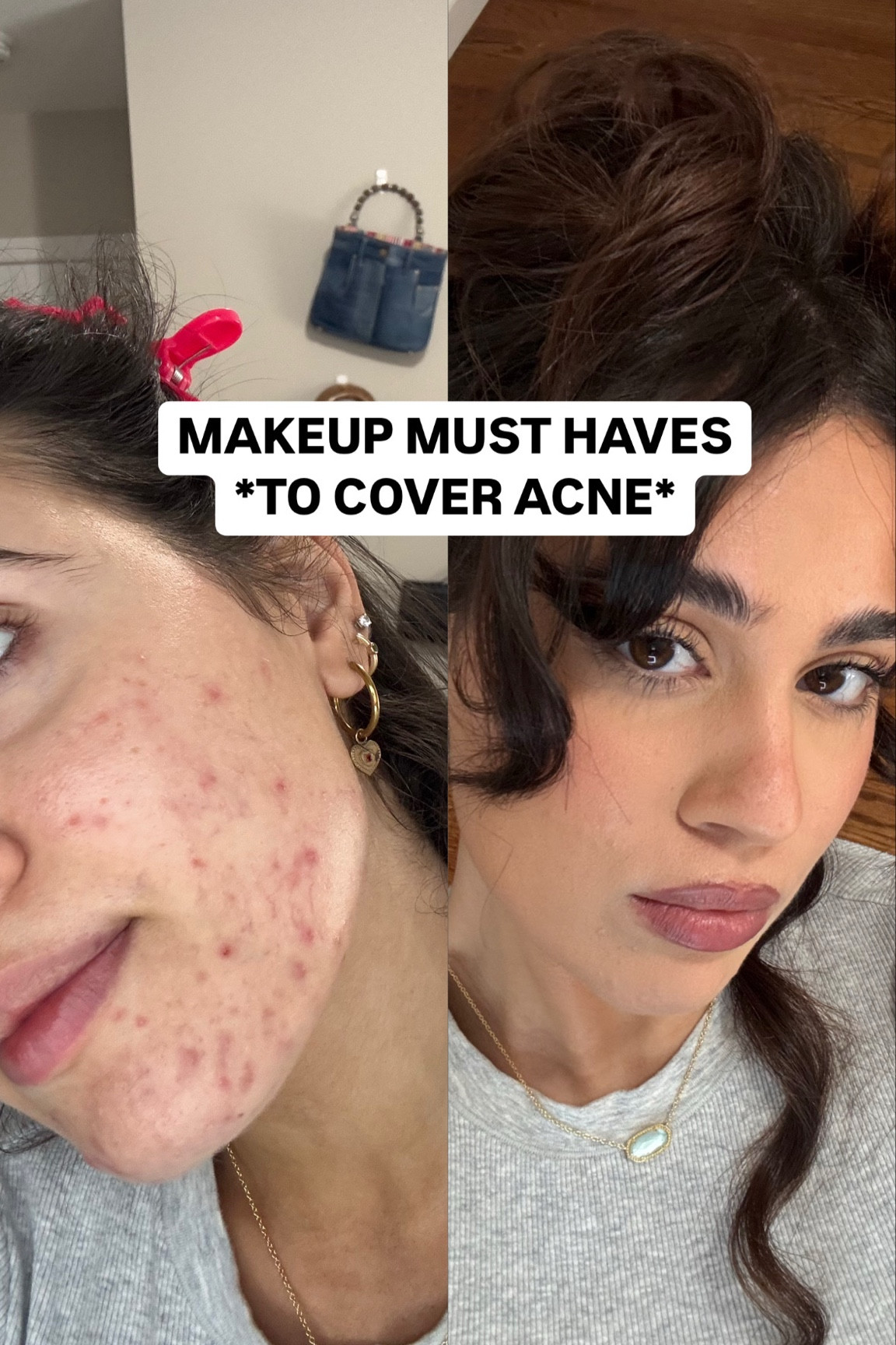 My go to everyday makeup routine #acne #makeuproutine #everydaymakeup 