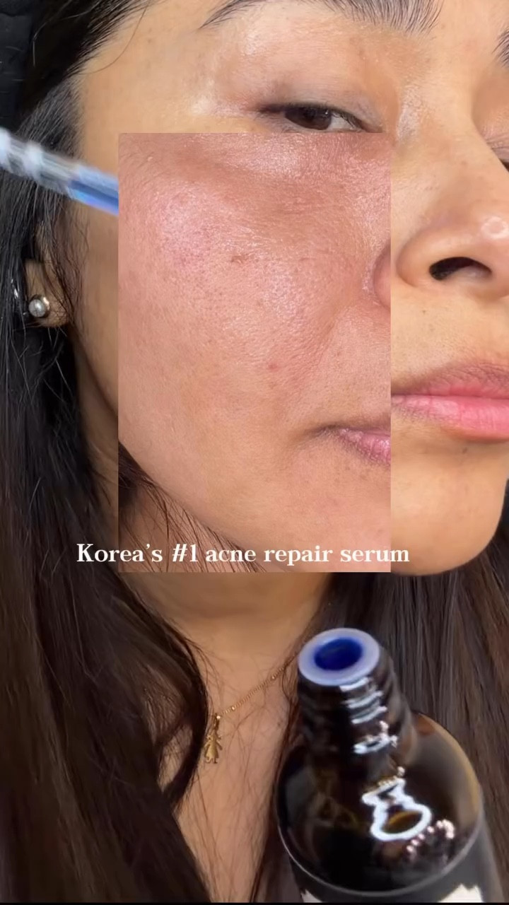 Korean serum for acne repair 💙

I tried the viral Blue Drop from, @klairs.us and now I understand why it’s ranked number 1 at Olive Young in Korea 👀

✨ Helps calm active acne
✨ Fades post-acne marks
✨ EGF for advanced skin repair
✨ Lightweight blue watery texture (100% natural color)

My skin feels smoother, clearer, and more even ✨

🛒 Amazon Spring Sale (3/25–3/31)
Use code KLAIRSEGF10 for an extra 10% OFF

#acnetreatment #Kbeauty #Klairs #KlairsEGFserum #koreanskincare