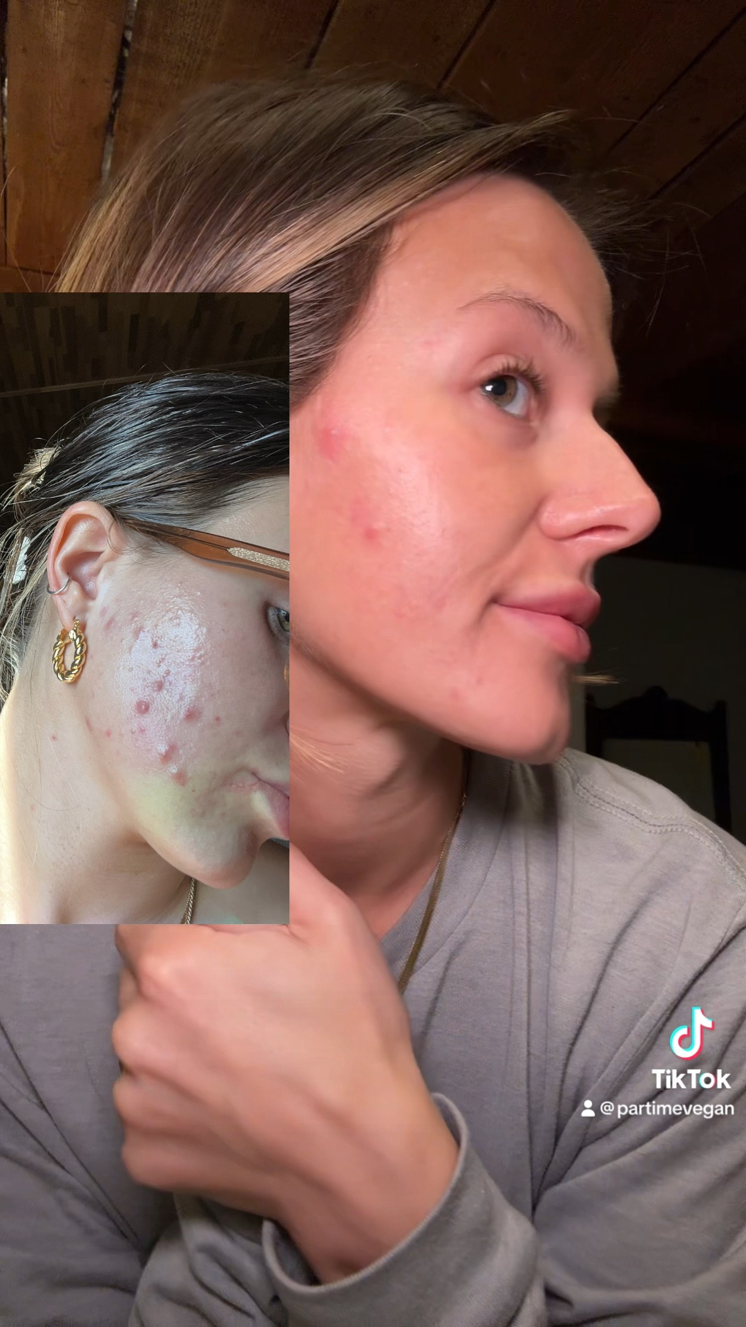 My skin has cleared up INSANELY in the past couple of months, and these 2 products have helped me do that while also keeping my skin HYDRATED, PLUMP, AND GLOWY! 

#LTKbeauty #LTKVideo