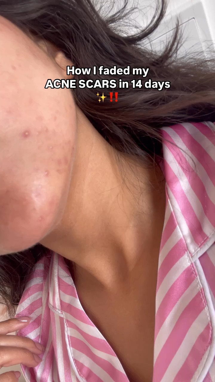 The BEST dark spot correcting serum out there‼️

korean skincare 
Anua skin care / glass skin / acne treatment/ acne scars

#LTKeurope #LTKsale #LTKbeauty