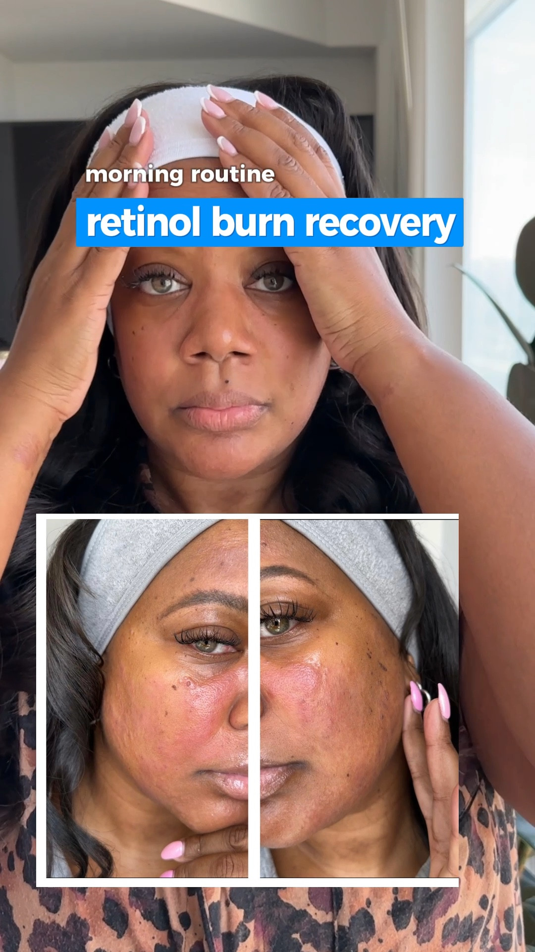 Healing from Retinol Burn - My Morning Routine that helped me heal my skin barrier in a week 🌞💫  
.
Here's my winning formula for a comeback:
Step one: Gently cleansing with water – my derm's advice to lock in moisture while soothing.
Step two: Introducing my hydration powerhouse, Beekman 1802 Milk Shake Hyaluronic Acid & Squalane Facial Toner Mist, for that dewy bounce. I love this stuff!
Step three: Cue the magic of CosRx Snail Mucin Essence, calming and nurturing my skin. I can’t believe I used anything from a snail - but my skin soaks this up as I pat it in.
Step four: Ole Henriksen's Peptide Strength Trainer steps in, rebuilding my skin's resilience. This has been a staple in my routine and definitely helped during this challenging time.
Step five: I'm sealing the deal with Dew-Glow Moisturizer SPF 50, a shield against the future while locking in all the goodness. My new fave sunscreen!
.
And guess what? These were all products I already had, no fancy fuss. Just pure soothing, healing, and hydration – no overdoing it, just what my skin needed. I’ll share my PM routine soon. 🌟
.
Please share your own skin revival secrets! Let's swap stories and spread the skin love.  #retinoljourney #skincare #antiageing #morningroutine #

#LTKbeauty