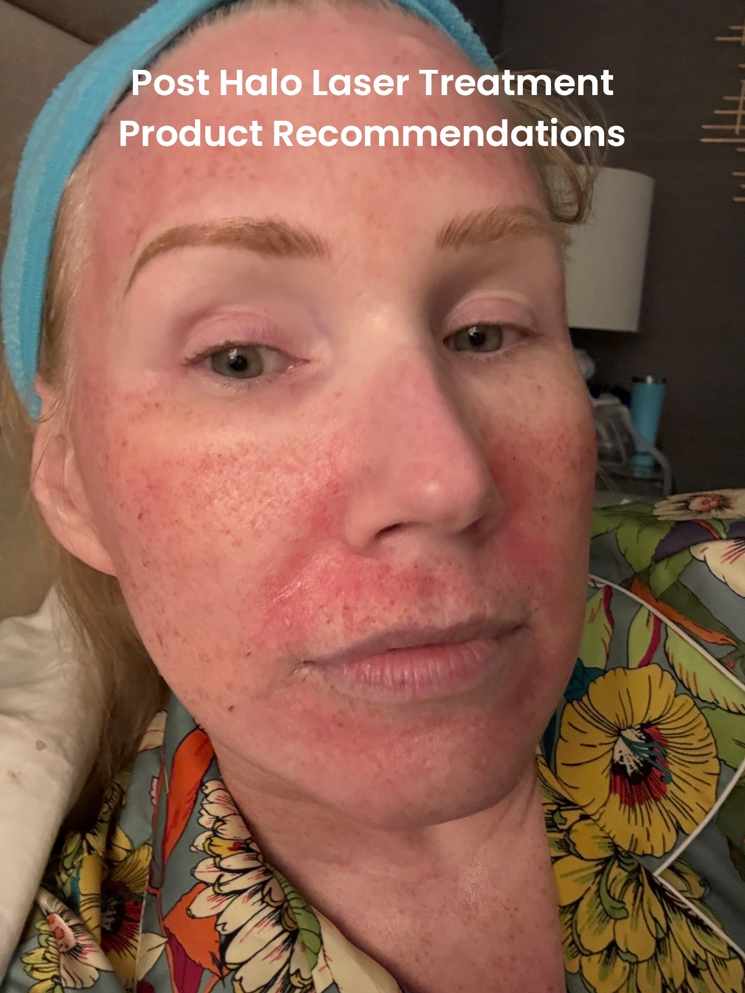 Does Halo laser treatment was intense, but here’s some products I used to calm my skin #lasertreatment #halo

#LTKBeauty