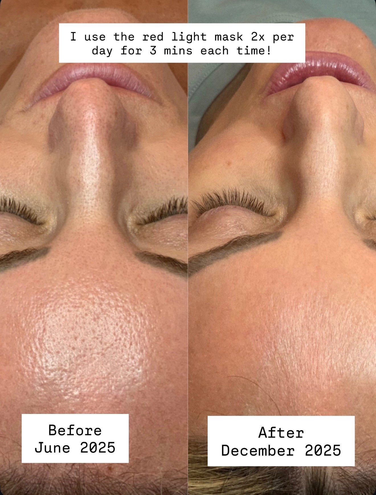 I’ve seen so many benefits in my skin since using my red light mask! Highly recommend!

Loverly Grey, red light therapy mask, skincare 

#LTKBeauty