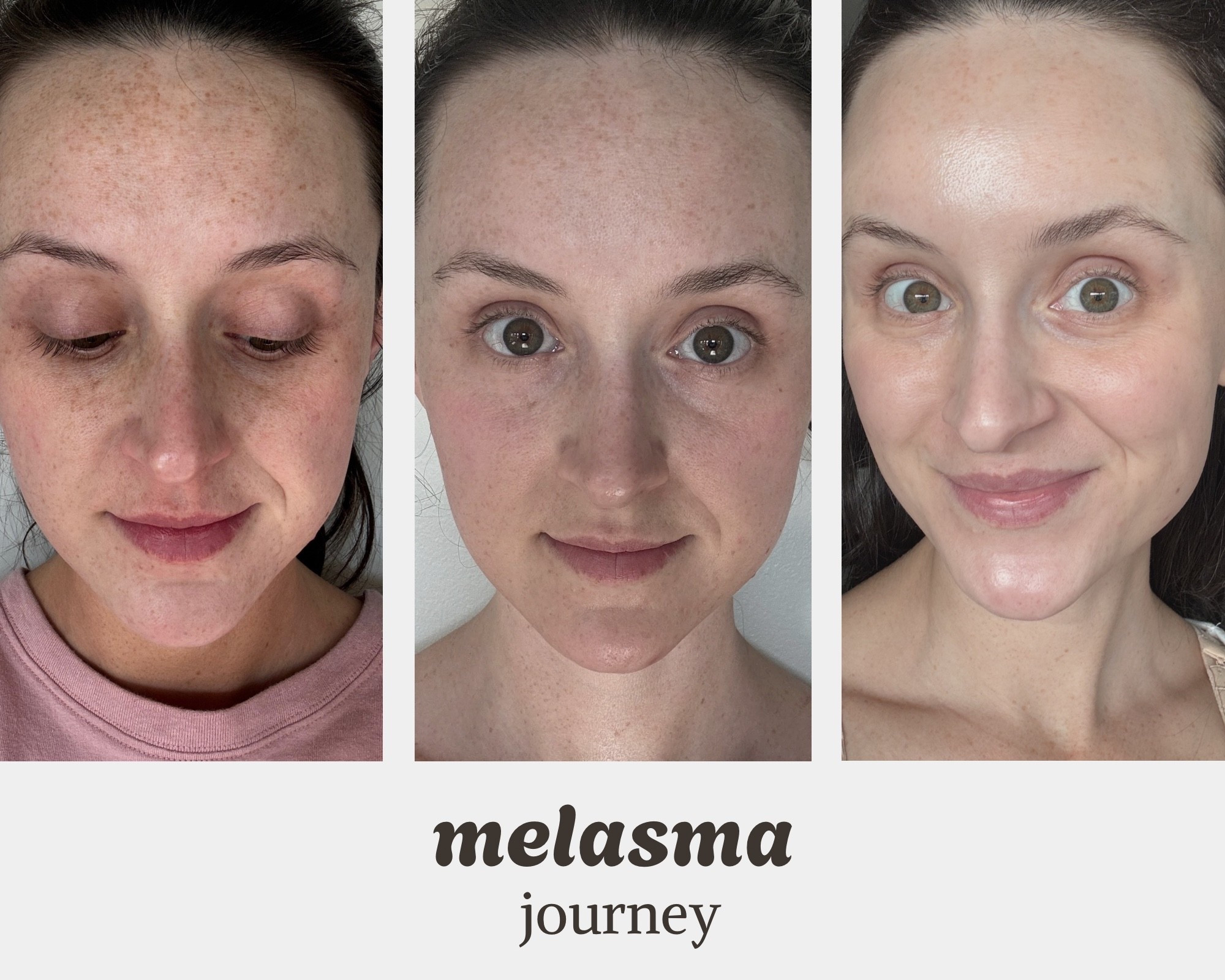 #1 product that changed my skin was Musely - no doubt! The other products I know have helped me are Acwell, Red light, SPF!!! 

#LTKFindsUnder50 #LTKStyleTip #LTKBeauty