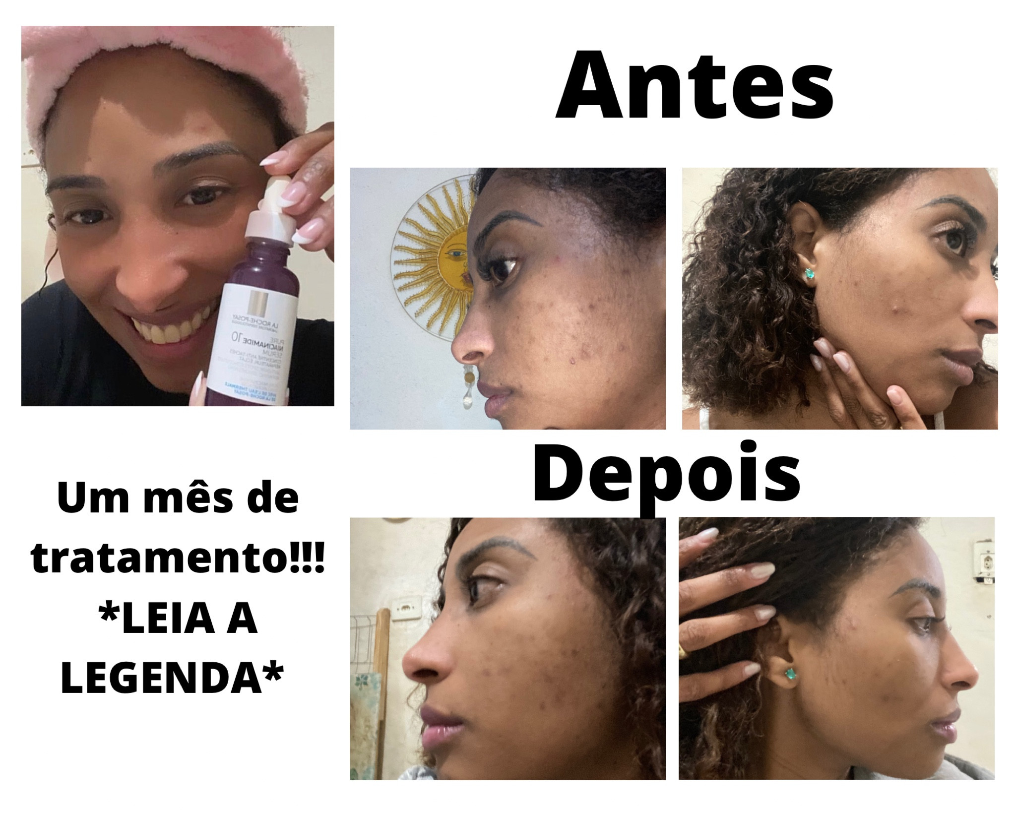 Minha pele do rosto é oleosa e como tenho a pele negra ela hiperpigmenta muito com as  lesões de acne, por isso todo ano no inverno faço tratamento com ácidos para clarear as manchas e secar espinhas, esse é o resultado de um mês de tratamento usando o Niacinamid 10 para clarear as manchinhas e uniformizar o tom da pele, quando uso o Niacinamid 10 sinto a pele um pouco oleosa por isso uso a noite, mais logo pela manhã já retiro e a pele não fica oleosa durante o dia. Faço uso dele associado a outro ácido para secar espinhas ( porém o outro ácido é vendido em farmácia e precisa de indicação médica). Atenção é muito importante o uso do PROTETOR SOLAR DIARIAMENTE, e lembre-se cada pele é única e consultar um dermatologista é indispensável para a saúde da sua pele.

#skin #care

#LTKbrasil #LTKbeauty
