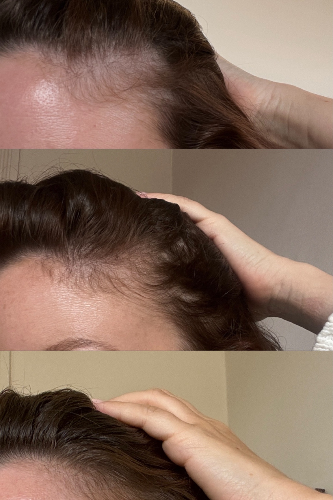 3 months of hair growth progress! Putting these next to one another I actually can’t believe the difference that scalp serum and supplements make! #hairgrowth #scalp

#LTKbeauty