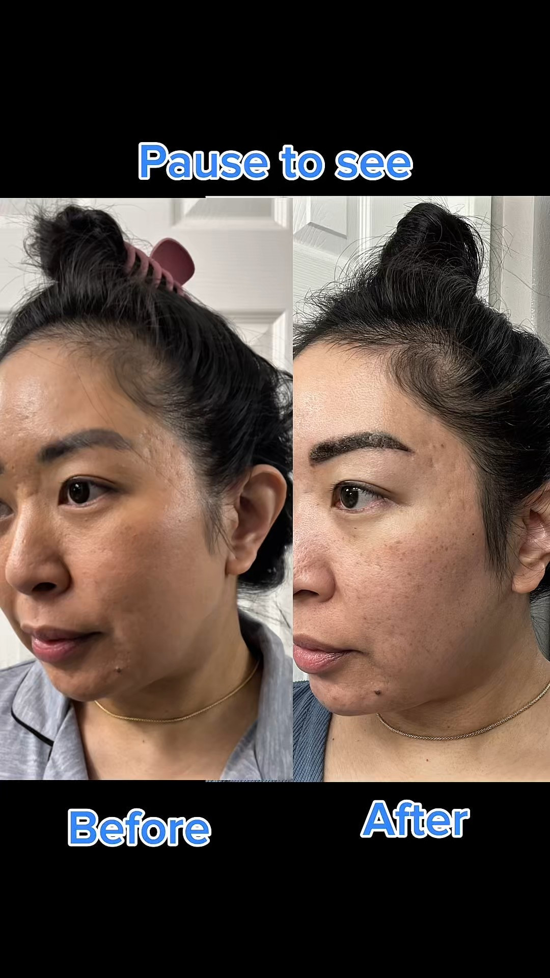 I reviewed this back in 2024. Just wanted to share this with my LTK mamas postpartum! Here’s my review of @myvitalvitamins collagen complex! I was going through some postpartum hair loss and this has helped me so much. You can compare the other videos I have posted before this that my hairline has improved so much when taking these supplements! Highly recommend this brand! I'll be buying more soon!
#UGCCreator #UGCCreatorJourney
#UGCContentCreator #UGCCommunity
#CreatingContent #UGCWork #ContentCreation #VitalVitamins #CollagenComplex
#CollagenSupplement

#LTKBeauty #LTKBaby