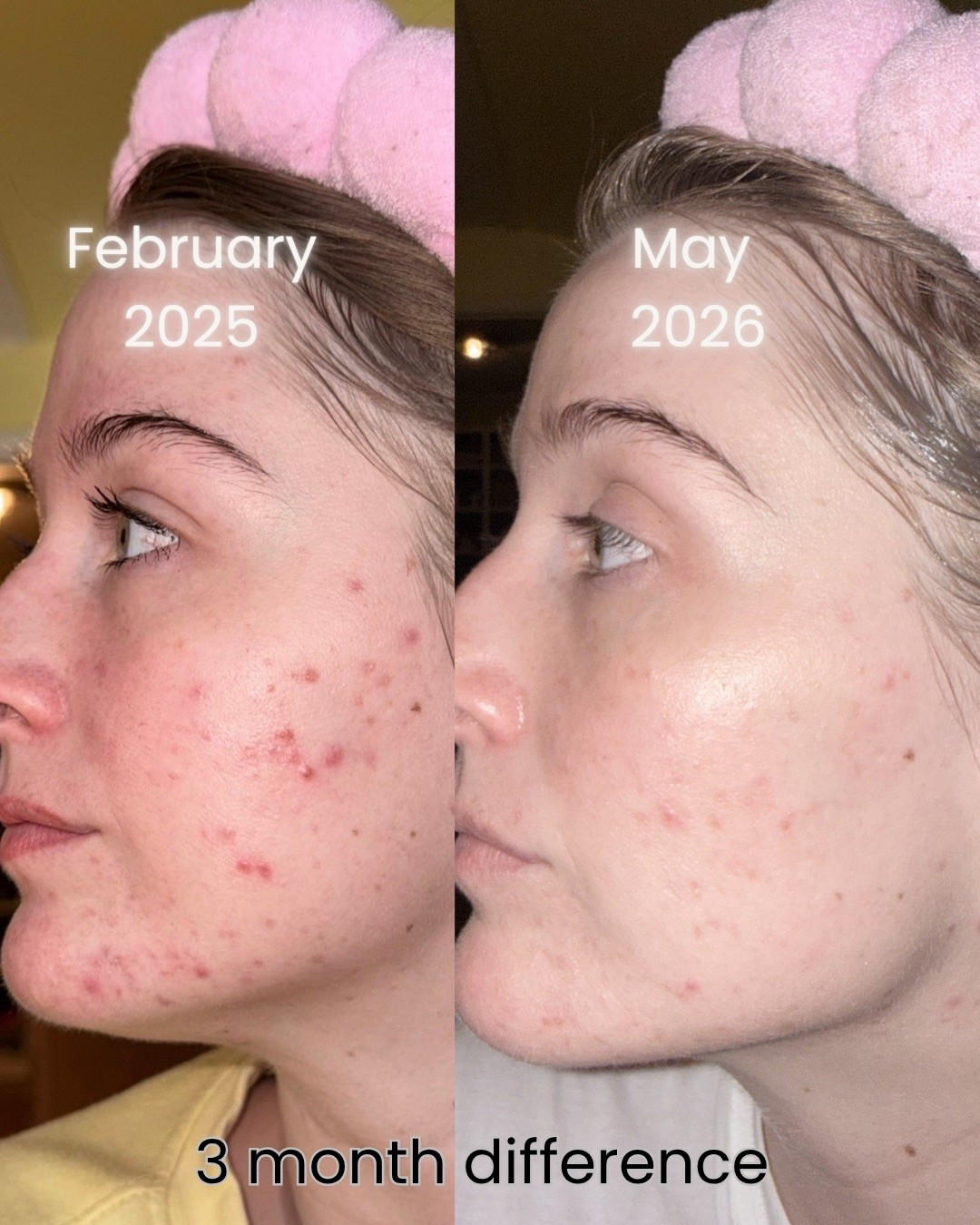 3 products that totally transformed my skin in 3 months!!

#LTKselfcare #LTKBeauty #LTKSaleAlert