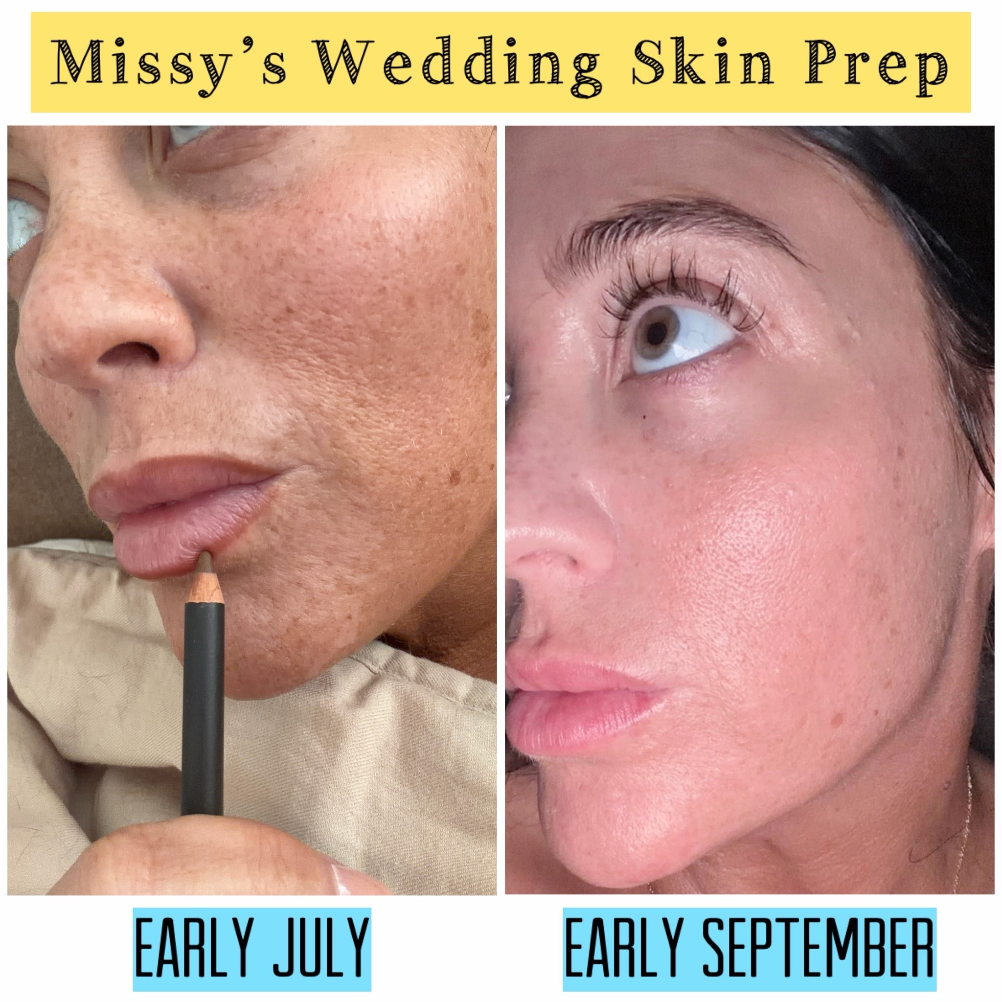 I’ve been working HARD on my skincare before my wedding, and the difference in my skin from early July to now is honestly wild. In addition to microneedling and Aquagold facials (1,000/10 recommend), my skincare routine has focused on keeping my face as nourished and hydrated as possible. These have been the 4 staple products that I’ve been using daily to help reach my skin goals:

1. La Roche Posay Cicaplast Balm Vitamin B5 Soothing Therapeutic Cream: I use this as my moisturizer in the 24-48 hours after microneedling or facials for procedure recovery.

2. BIOEFFECT EGF Growth Factor Power Serum: I wish this wasn’t as expensive as it is, because it REALLY works, and I 100% will keep using it. Iconic for a reason. I’ve even had some friends say that it makes the effects from their Botox treatments last longer.

3. SkinCeuticals Vitamin C & E Serum with Ferulic Acid for skin radiance and anti-aging

4. SkinCeuticals A.G.E. Interrupter Ultra-Lifting Serum for skin lifting and tightening

…and a lot of moisturizer! I’ve been doing the same routine every day, and my skin keeps getting better. I’m truly blown away by these results in such a short period of time. Who would have thought?

#LTKBeauty #LTKWedding #LTKselfcare