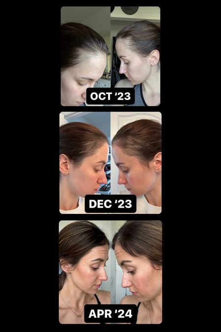 Best scalp serum for postpartum hair loss 💚 first photo is from 3 months pp! 

#LTKbeauty