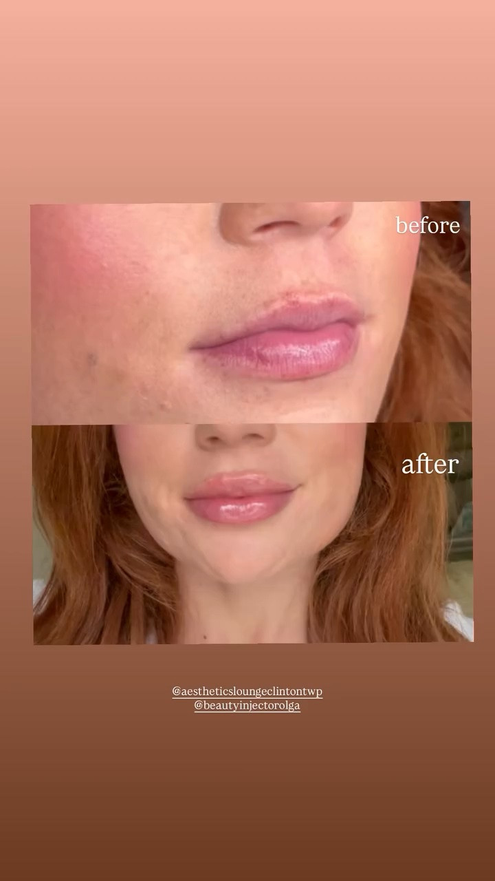 after  before  @aestheticsloungeclintontwp 
@beautyinjectorolga