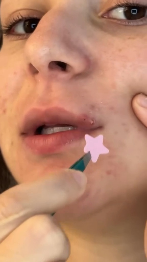 These lip pimples are possibly the most painful spot debate me 

Follow along on this journey of healing my acne🕺

🔗 to patches on ltk ofccc

#acnejourney #acneproneskin #pimplepatch #pimplepatches #acne