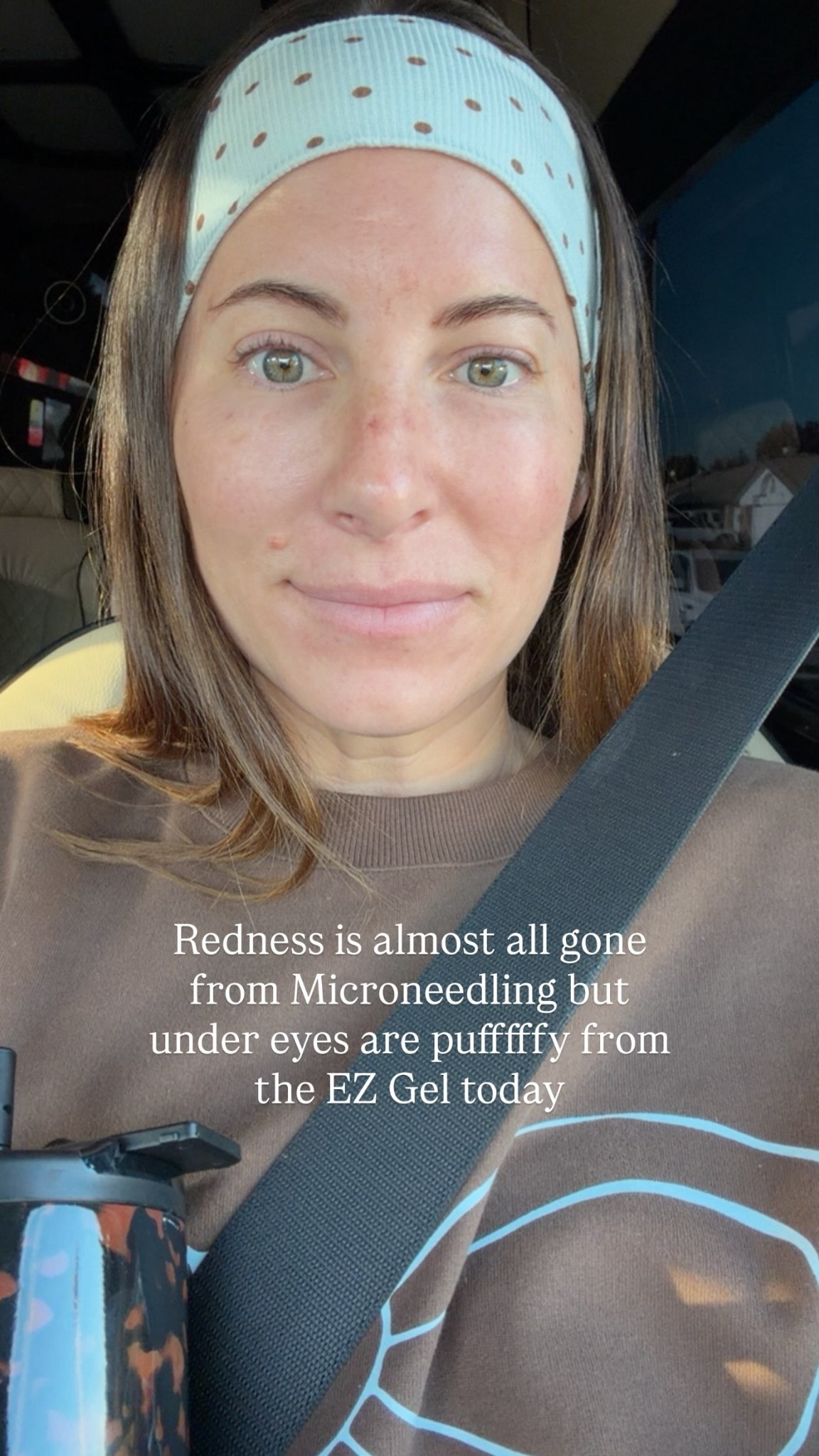 Redness is almost all gone from Microneedling but under eyes are pufffffy from the EZ Gel today