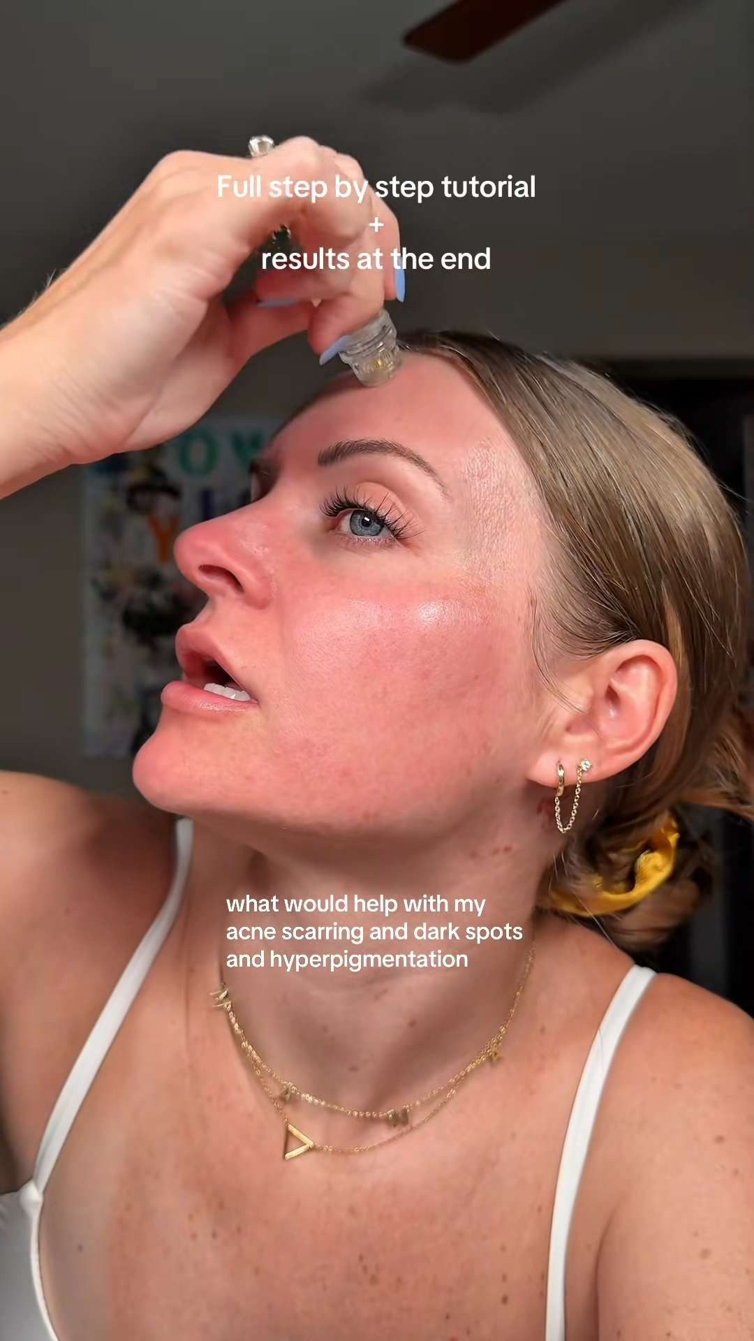 qure is the way to go if you have been wanting to try microneedling! wayyy more affordable and who doesn't love an at home treatment 😍 

 #LTKgrwm #LTKmomlife #LTKselfcare
