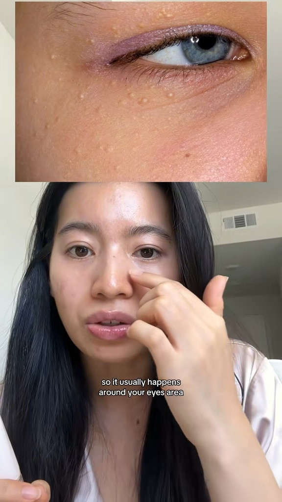 Beauty of Joseon : retinal eye cream - it works soooo well omgg! My milia is literally gone after months of using it every night! 

#LTKstorytime #LTKBeauty #LTKselfcare