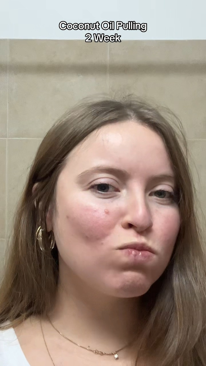 Coconut oil pulling week 2!

#LTKWatchNow #LTKBeauty #LTKU