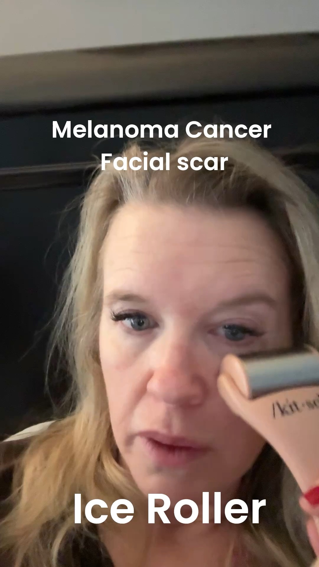 Ice roller 
Why you need one..

I am on a melanoma cancer journey, center stage on my face.

I have a large scar on my face and the ice roller helped to get me through the after surgery recovery,  the ice roller helped with swelling, then to use during the  healing process for the scar .
The roller helps  to massage out the scar tissue.

Don’t have a scar? Helps with headaches, de-puffing the face & eyes, feels great with facial sheet masks too! 


#LTKBeauty #LTKdayinmylife #LTKselfcare