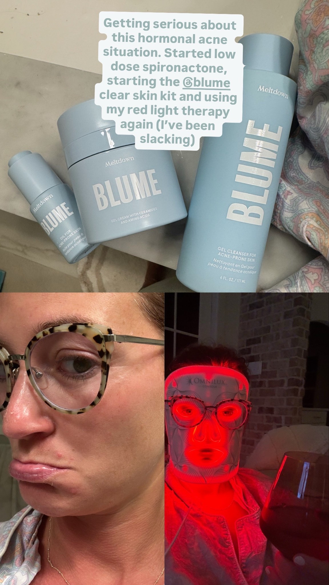 Let’s fight this hormonal acne situation! Starting the Blume clear skin kit!

#LTKdayinmylife #LTKBeauty