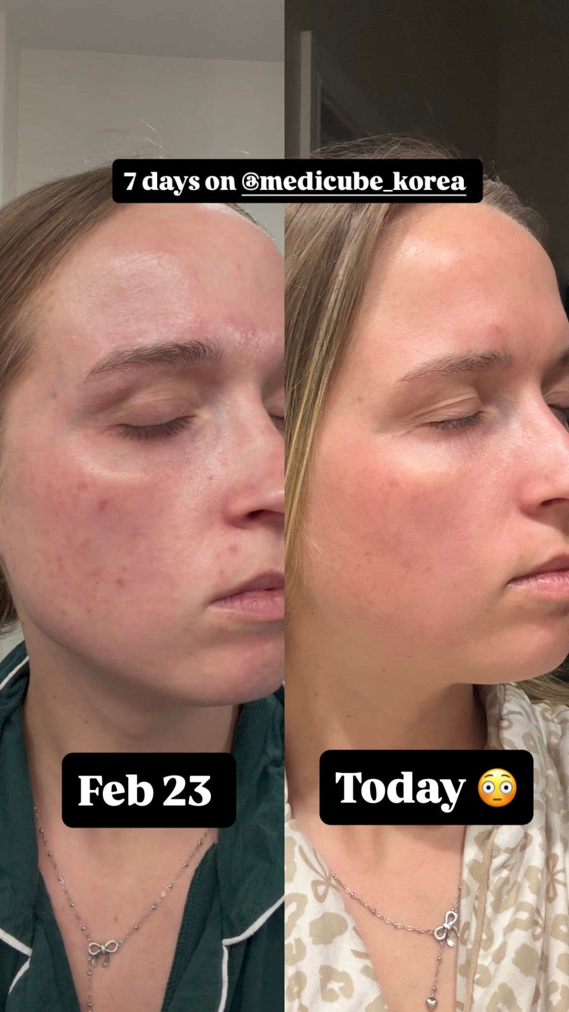 One week transformation with medicube!

#LTKselfcare #LTKmorningroutine #LTKSpringSale