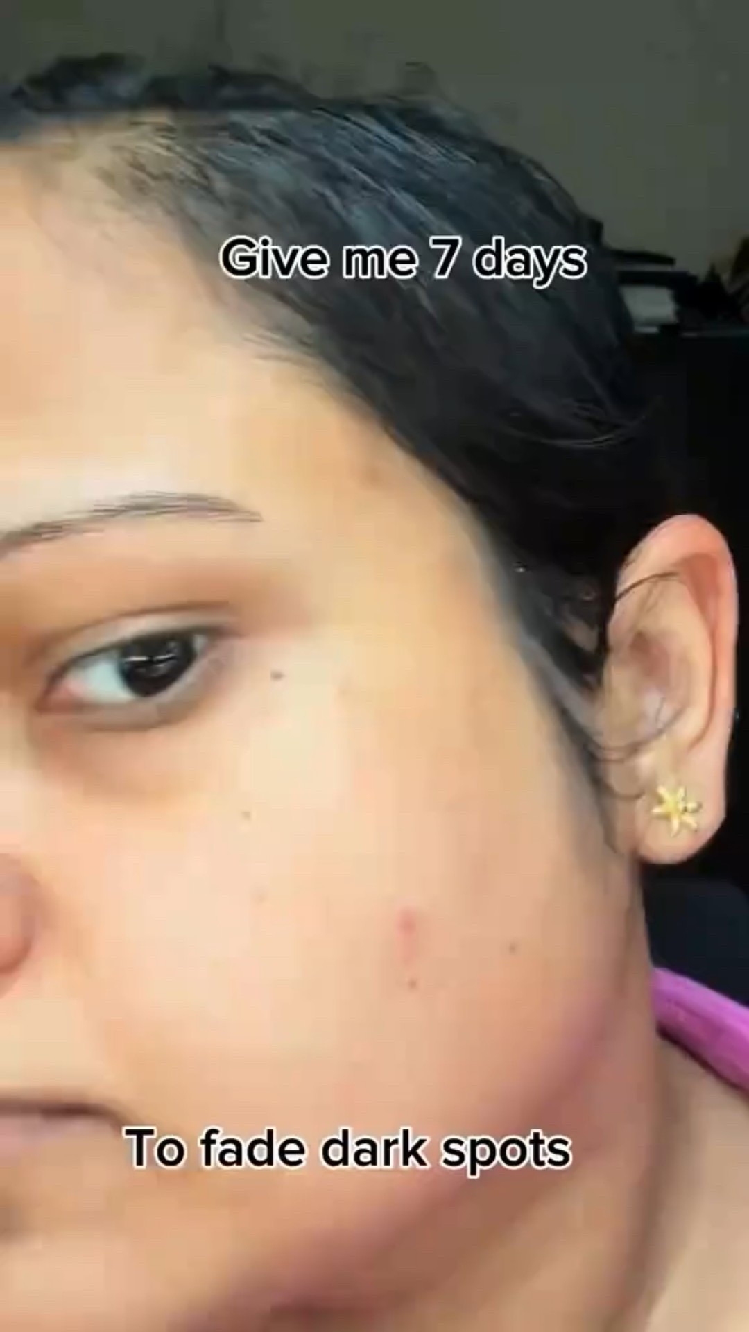 Tried the Seoul 1988 retinal serum from
@ksecret_global for 7 days straight and I cans definitely see a difference in fading one of the dark spots right in the middle of my cheek. It’s not irritating, non sticky texture has ingredients such as black ginseng. Highly recommended! 
Yesstyle rewards code: IMASHAAB3
#ksecret #seoull988 #retinalserum #retinal #darkspots #pigmentationcare #koreanskincare #creatorsearchinsights #beauty #seoul1988retinalserum #nyccontentcreator