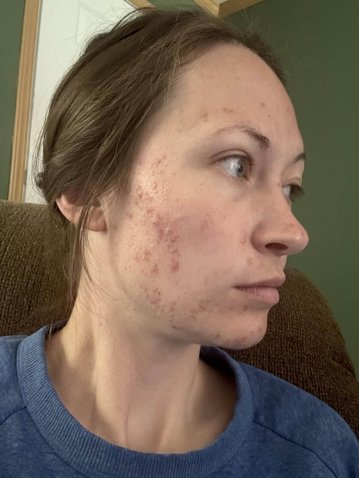 Medicube Zero Pore Pads Mild 2.0 (70 units) - Gentle Calming Toner Pads for Exfoliation, Minimizi... | Amazon (US)