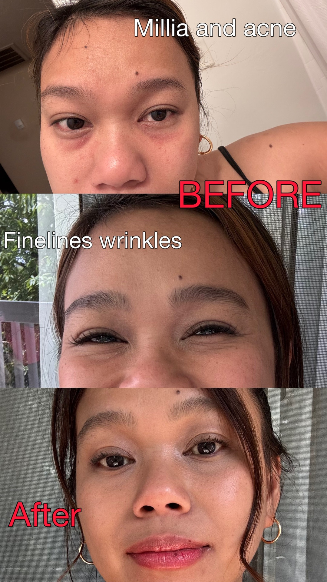 I struggled with milia, acne, and fine lines. I started learning more about skincare and slowly built a routine that works for me. One of the products I genuinely enjoy using is the Beauty of Joseon serum.

I’m not saying it’s magic or that it erased all my imperfections. but it helped with some of my skin concerns and made me feel more confident in my skin. 🤍

I’m sharing this because maybe someone out there feels the same way I did. 🫶

#LTKBeauty #LTKselfcare #LTKmorningroutine