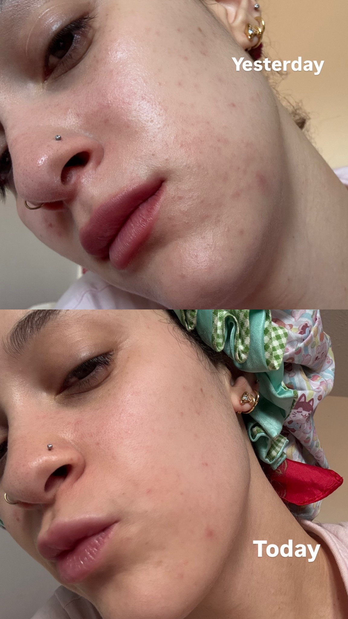 Tagged my routine to immediately calm inflammation & irritation. I had a complete and totally reaction (probably because I try so many new things all the time) and it continued to slowly build up and get worse over the course of a few hours. After doing this routine my skin calmed over night and I was only left with some breakouts which is a lot better than being hot and itchy! 

#LTKBeauty #LTKU