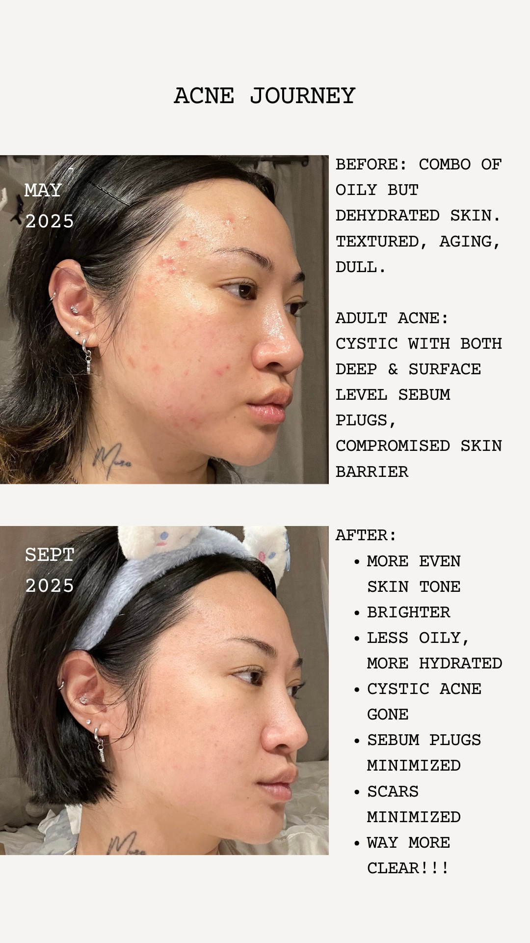 10% off rewards discount code: INFDIVI10. 
My skincare products and routine for acne including toner, serum/ampoule, cream, and device.  This is the Korean beauty skincare that has been ridding my acne (cystic acne, sebum plugs/blackheads/whiteheads) while also helping my combo oily and dehydrated skin turn to more even skintone, brighter, minimizing pigment from scarring. I have been fighting acne all my life and finally!!!! something that actually works. No surprise, it's korean skincare. My first additions and absolute stapes are the skin1004 centella ampoule and hada labos premium lotion. The lotion restored my compromised skin barrier, and the ampoule helped heal and renew EVERYTHING. Especially my sore spot which is acne. I then added the lightweight, watery centella toning toner for light exfoliation and alternated that with the hada labo lotion that is thick and hydrating. To maintain, I tried the medicube age-r device that I unfortunately.... hate that I LOVE. Just PLEASE carefully read the pamphlet and watch their official tutorials. It's extremely important that you do or you will end up ruining your skin!! I use my beloved COSRX snail mucin cream that i've been repurchasing for ages. It helps the device glide for a longer time and the snail mucin has many benefits as well like hydration, slows down aging skin, and brightens complexion. Best korean skincare!! 

 #acneskincare #LTKFallSale #LTKFindsUnder50 #LTKBeauty