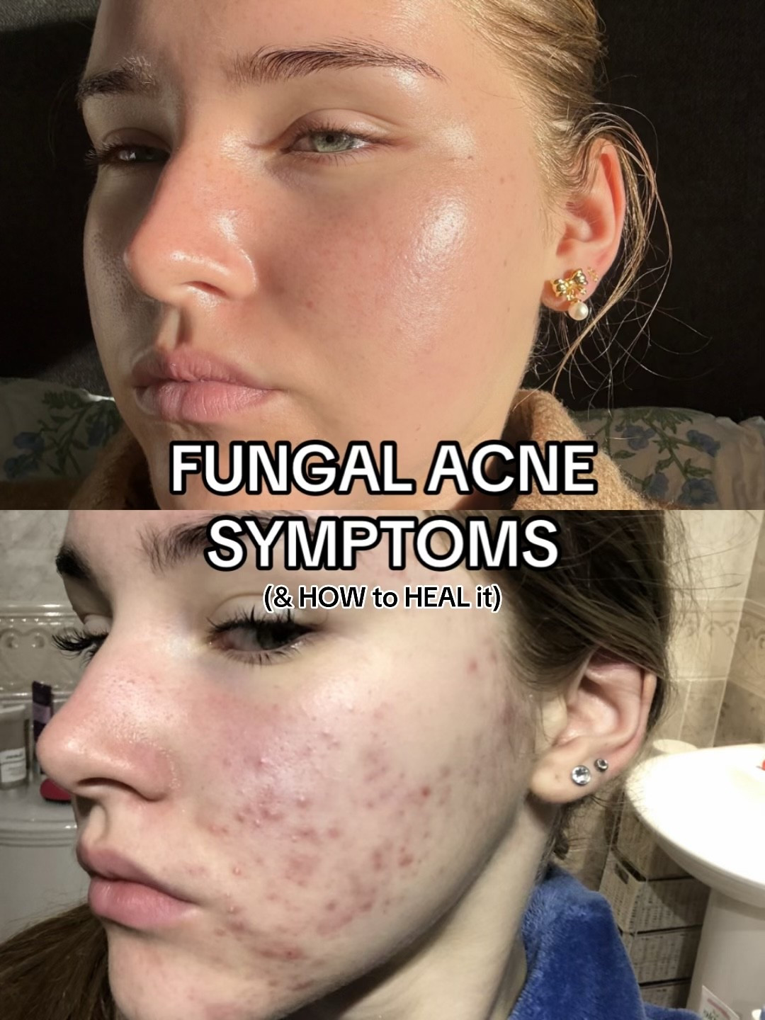 the best products to clear fungal acne + keep it gone!! Code LIFEWITHMILS gives discount on Dr Sam’s + YesStyle !