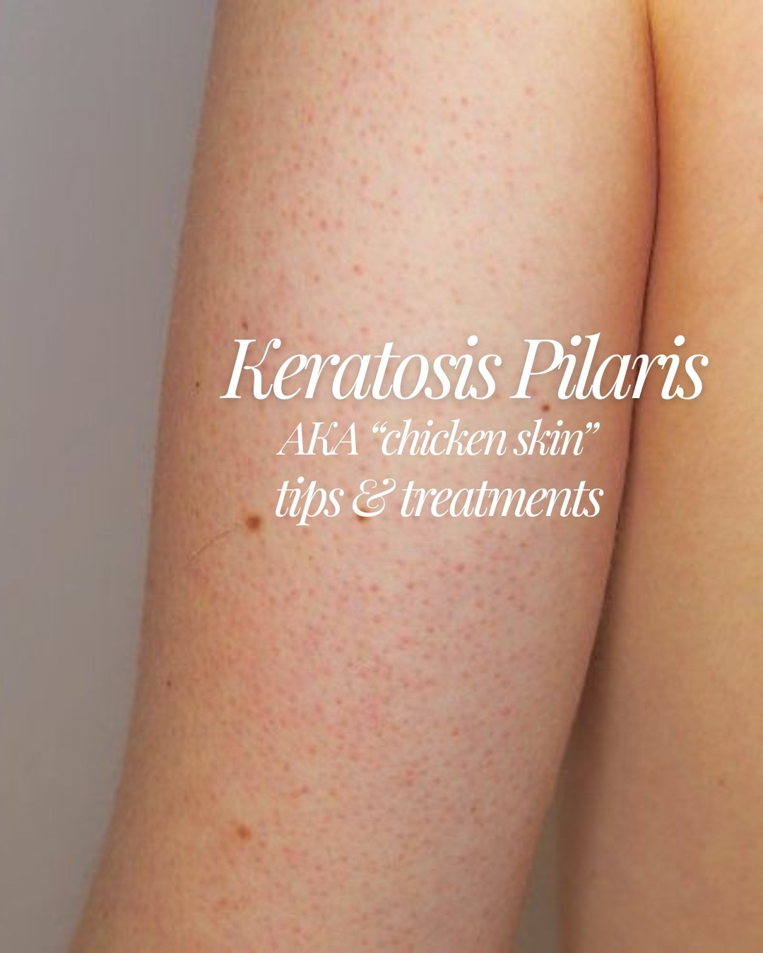 KP is one of the most common skin conditions I see — and one of the most misunderstood.🙇🏻‍♀️

Those tiny bumps? They’re caused by keratin buildup, not clogged pores from dirt. Which is why aggressive scrubbing usually makes it worse.🙅🏻‍♀️

The fix isn’t harsh — it’s consistent: • Chemical exfoliation (lactic acid, salicylic acid, urea) • Barrier repair (ceramides, hydration) • Patience✨

Most people overdo it and damage their skin barrier… but if you treat KP like a dry skin condition — not acne — your skin will respond! 🧴 

#LTKgrwm #LTKmorningroutine #LTKselfcare