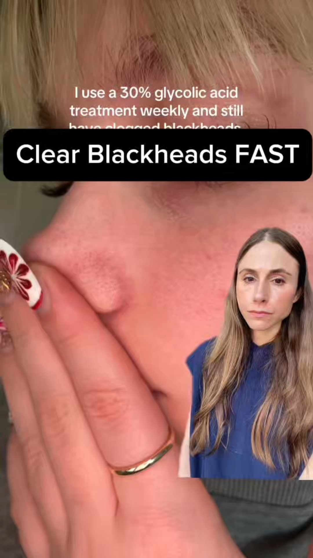 How to Clear Blackheads FAST 

#LTKBeauty