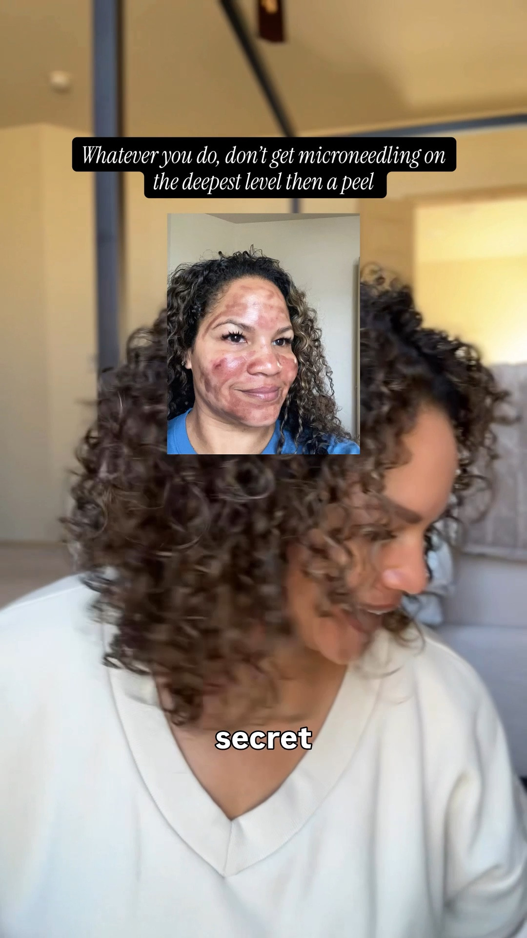 Microneedling and  peels can be great, just not the deepest level then a peel my skincare journey and recovery. Now I get stopped often about my skin. Coleman compound pads and retinol have been a game changer. 

#LTKOver40 #LTKgrwm