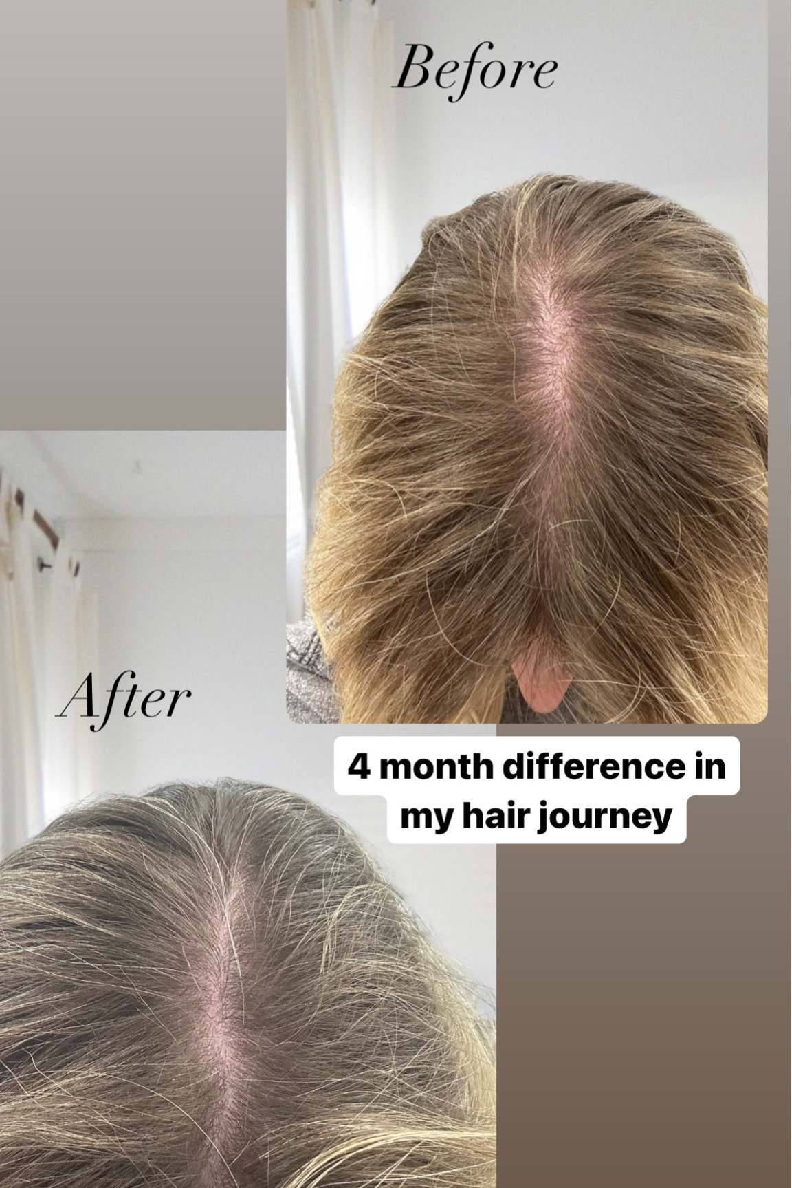 Here’s what I used for the past four months to see these results!! #hairgrowthjourney #hairgrowth

#LTKbeauty