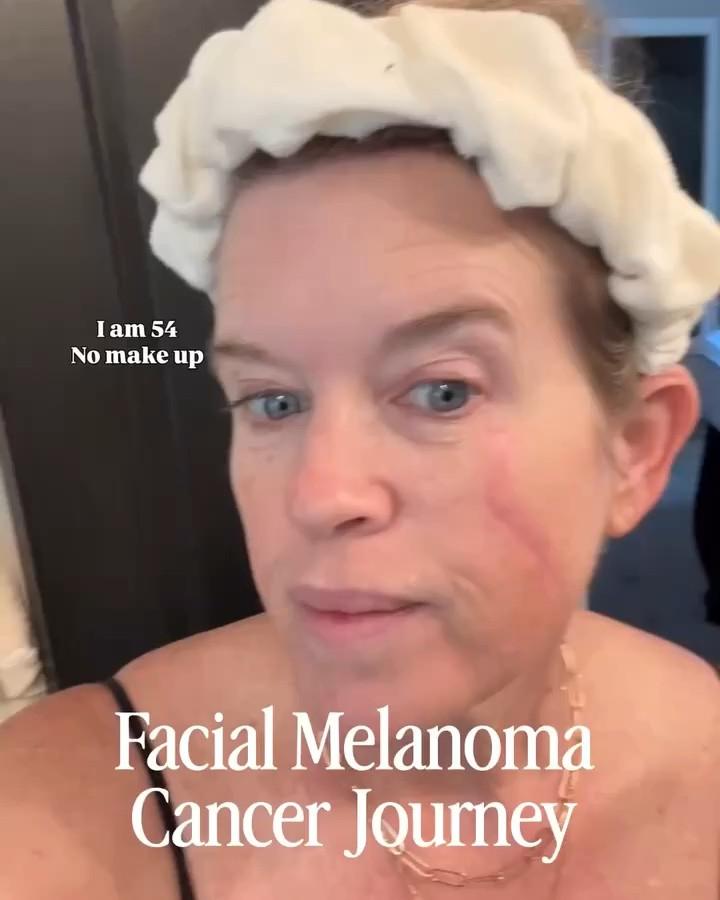 Facial Melanoma Cancer Journey 
Part 8

❤️I’ve found…when life deals you unexpected hurdles, and things that could potentially knock you down… you’ve gotta, put on those big girl panties and turn it around! 
Stay strong, fall to your knees🙏🏻 And put it in  Gods hands…. Then you can let go and follow the process, and with that comes the strength to look at the good you could do and share, along with finding ways to make everyday special…

⚠️Self-care Saturday-
Mohes facial surgery in January, which left a facial scar from eye to jaw..
Months of healing and 3 facial laser treatments with 3 more to go…

 ✔️Products and tools I’ve been using and would highly recommend to help heal facial scars & take care of skin over 50

🌸A few tips to romanticize everyday life, my daily green drink, which is good for everyday health, but also helps heal you.

The mask I was unexpectedly surprised with… 

Comment “ Shop” and I’ll send you the links and details For the products I use ..

Comment “Drink” for my daily green drink and morning NAD supplement 

I’ve been sharing my journey since December… and have 7 other parts here in my feed, if you want to look back and see the process and journey…
I also gave a highlight bubble with saved info etc.

⚠️Reminder to Make your skin check appointment ❤️

Melanoma Cancer scar | over 50| healing| Romanticizing your daily life|

#LTKgrwm #LTKOver40 #LTKBeauty