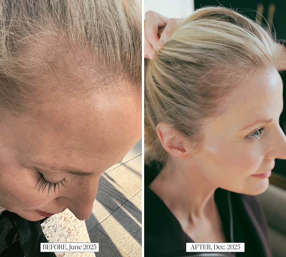 I never expected to love this supplement.

Honestly, at first, the idea of adding four more pills to my daily stack felt like a lot, and knowing I’d have to wait weeks (maybe months) to see results? Not exactly motivating. Patience has never been my strong suit.

Before committing to Nutrafol, I tried multiple serums. None of them made much of a difference, and they all left a residue in my hair — basically forcing me to wash it more often, which I really didn’t want to do.

Eventually, I decided to go all in and test Nutrafol for three months. The brand recommends sticking with it for at least that long to see noticeable changes, but I actually started seeing results just after the two-month mark… which felt very exciting!

Here’s what changed for me:

✔️ Growth right at my hairline where it had been very sparse
✔️ Fuller, thicker strands overall
✔️ Significantly less shedding — when I blow dry now, my hair no longer fills the brush or covers the bathroom floor

#LTKBeauty #LTKOver40