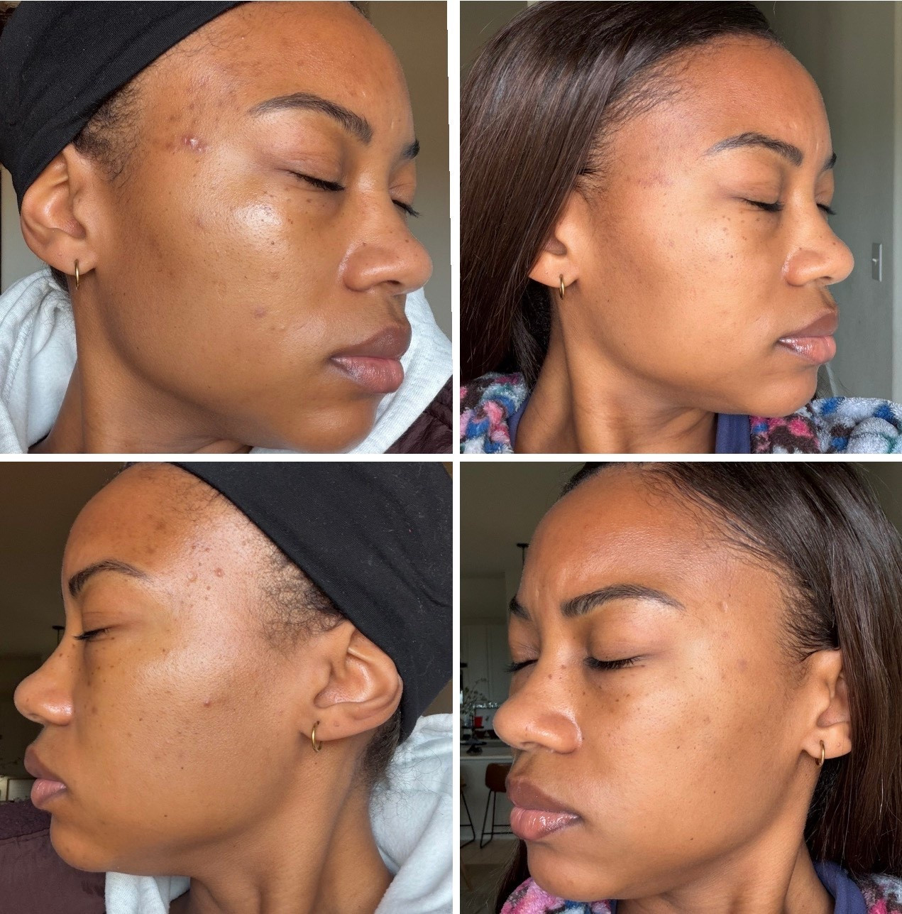 Chat gpt is seriously my best friend. I took a picture of my face and sent it to chat gpt and it told me to try azelaic acid. This is 12 weeks difference. 
#darkspots
#acnescars

#LTKmorningroutine #LTKmomlife #LTKselfcare