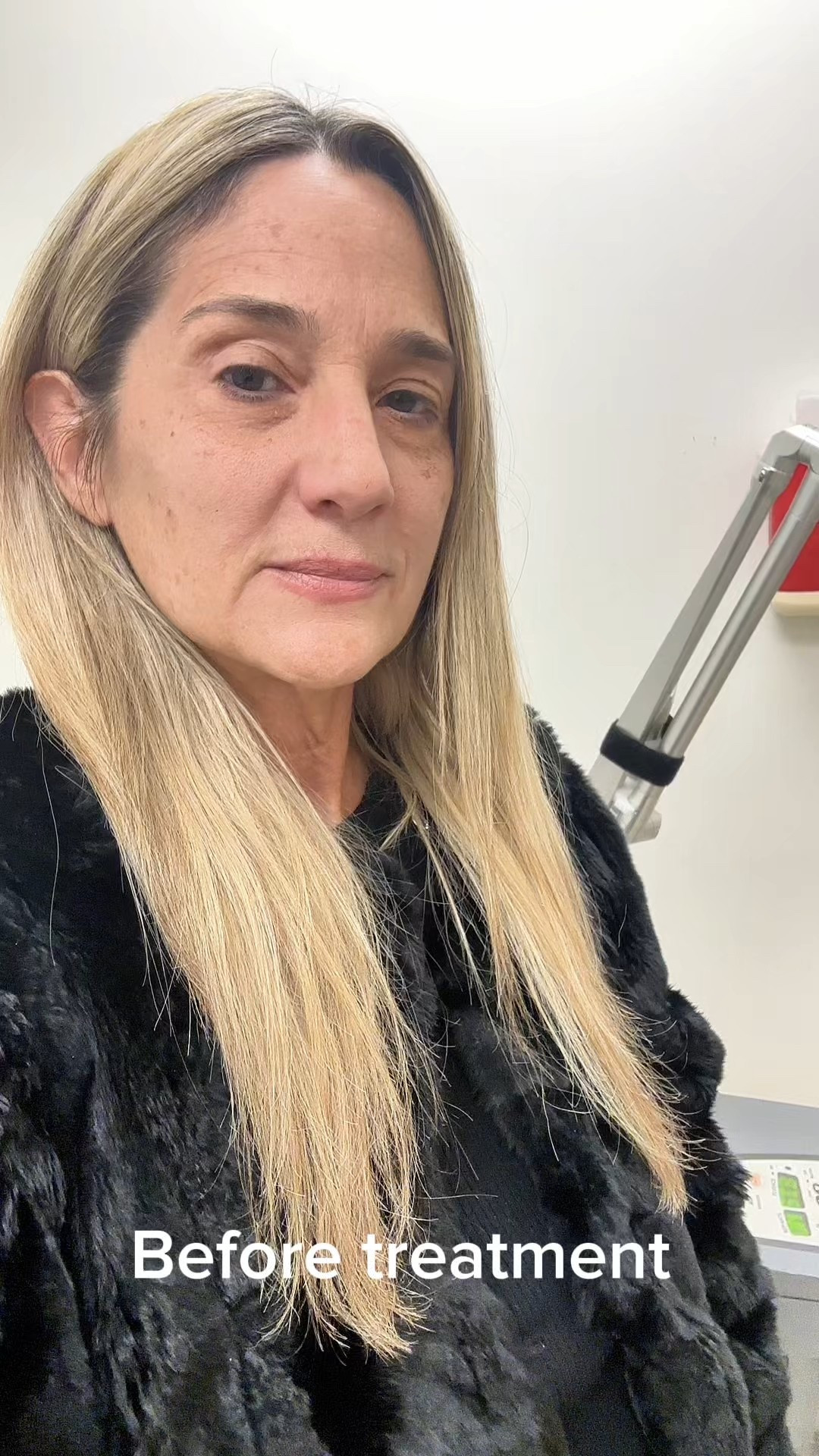 This is the MD recommended face tint that I used after my laser, it covered the dark spots and also kept the UV rays from repigmenting the brown spots.

#LTKBeauty