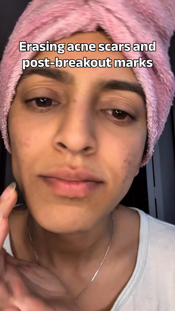 Using the NINELESS Azelaic Acid Serum + Tranexamic Acid Serum bundle to target acne scars, post-acne marks, redness, uneven texture, and hyperpigmentation ✨ YesStyle discount- PRIYA1512

The azelaic acid serum helps calm acne and smooth texture, while the tranexamic acid serum helps fade dark spots and brighten skin tone. Also testing the azelaic acid + tranexamic acid sheet masks for extra hydration and glow support.

#acnescars #hyperpigmentation #azelaicacid #tranexamicacid #torontougc