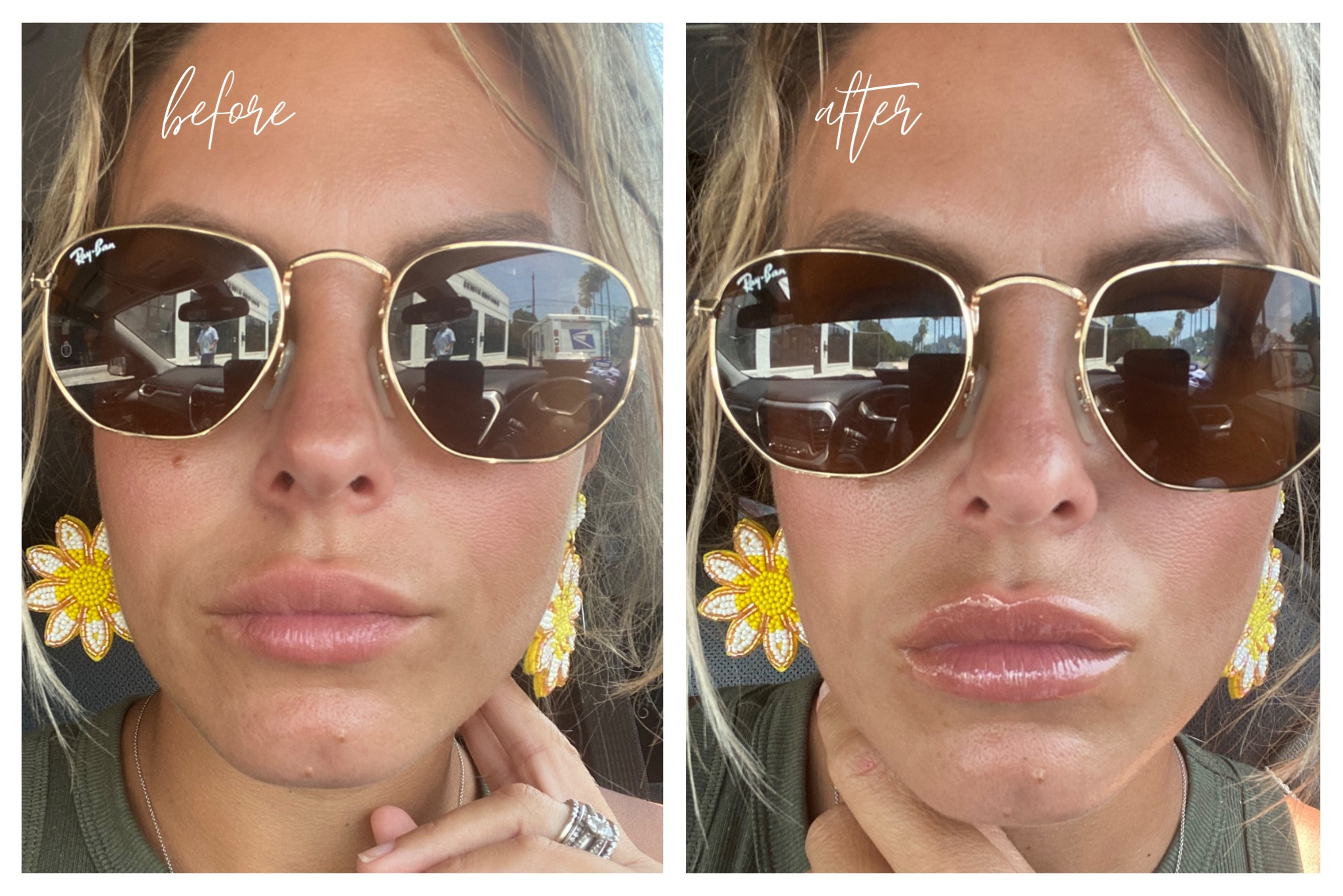 Before & After Collagen Lip Plump! 

Also, my Raybans are still 20% off! 

#LTKbeauty #LTKsalealert #LTKunder50