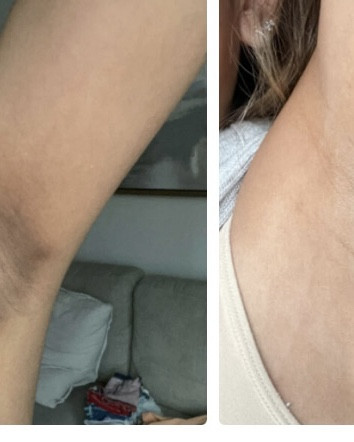 El embarazo ha manchado mi piel, ya mi bebé tiene un año y sigo padeciendo de esto. Vi este review y quedé impresionada voy a comprarlo e intentarlo 

#LTKCyberWeek #LTKselfcare #LTKBeauty