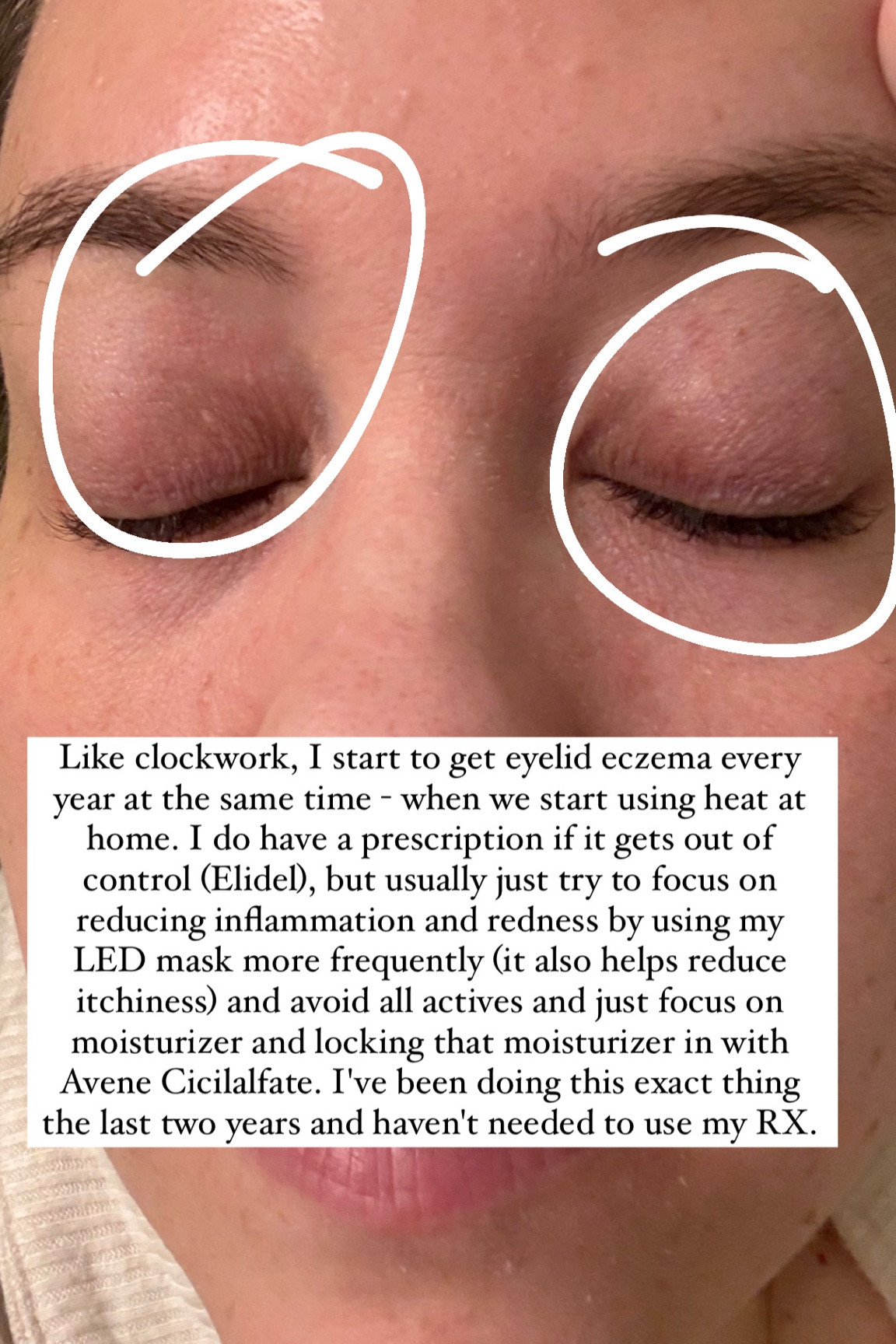 Eyelid eczema helpers. 

Stop using actives
Use LED mask every day to reduce inflammation (helps with itchiness and redness too)
Don't use any eye creams or actives - just apply a thick moisturizer (I like Delikate Moisture cream - it's almost like a balm, but still a cream) and then top with Avene Cicalfate. 

I love Avene Cicalfate because it's kind of like diaper rash cream - thick enough to help protect the barrier, but also moisturizes and soothes. I love to use it around my nose when it gets chapped or any other eczema spots  