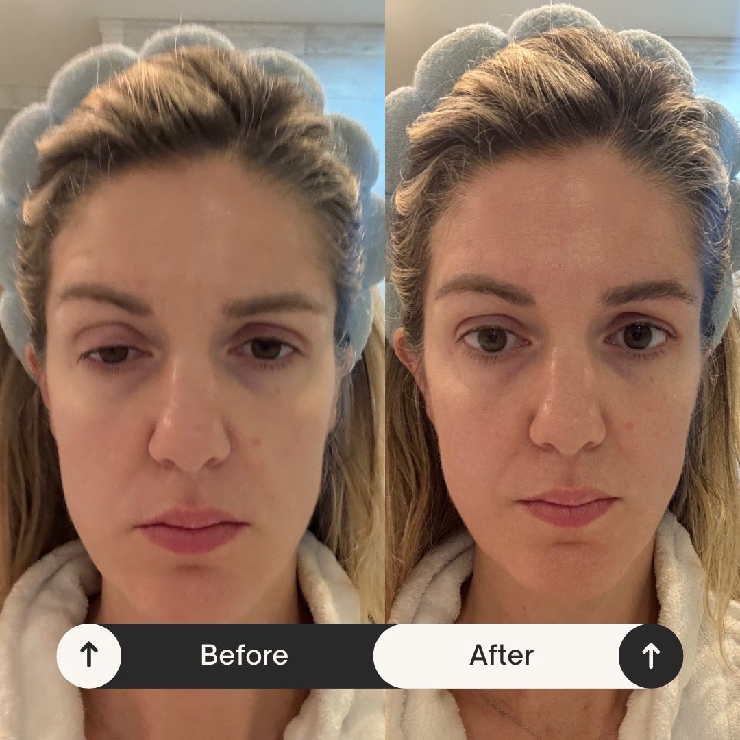 This is embarrassing to show but there’s literally five minutes between these two photos. The “before” is when I woke up and the “after” is after using this micro current device for four minutes! 