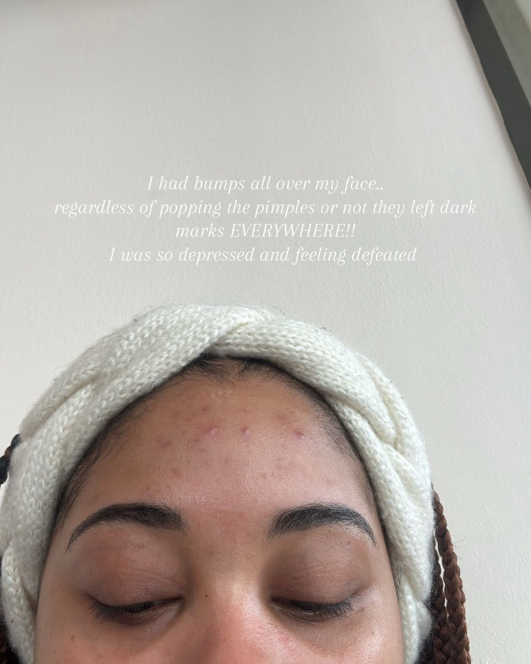 This is how I got my skin clear and keep it clear!! Some time you really do need a professional ✨✨✨

#LTKBeauty #LTKStyleTip