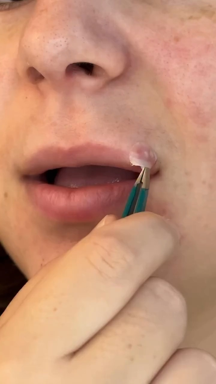 Here’s the juiciest pimple you’ve ever seen 

@get_rael 
#acneproneskin #acnejourney #pimplepatches #pimplepatch #acne