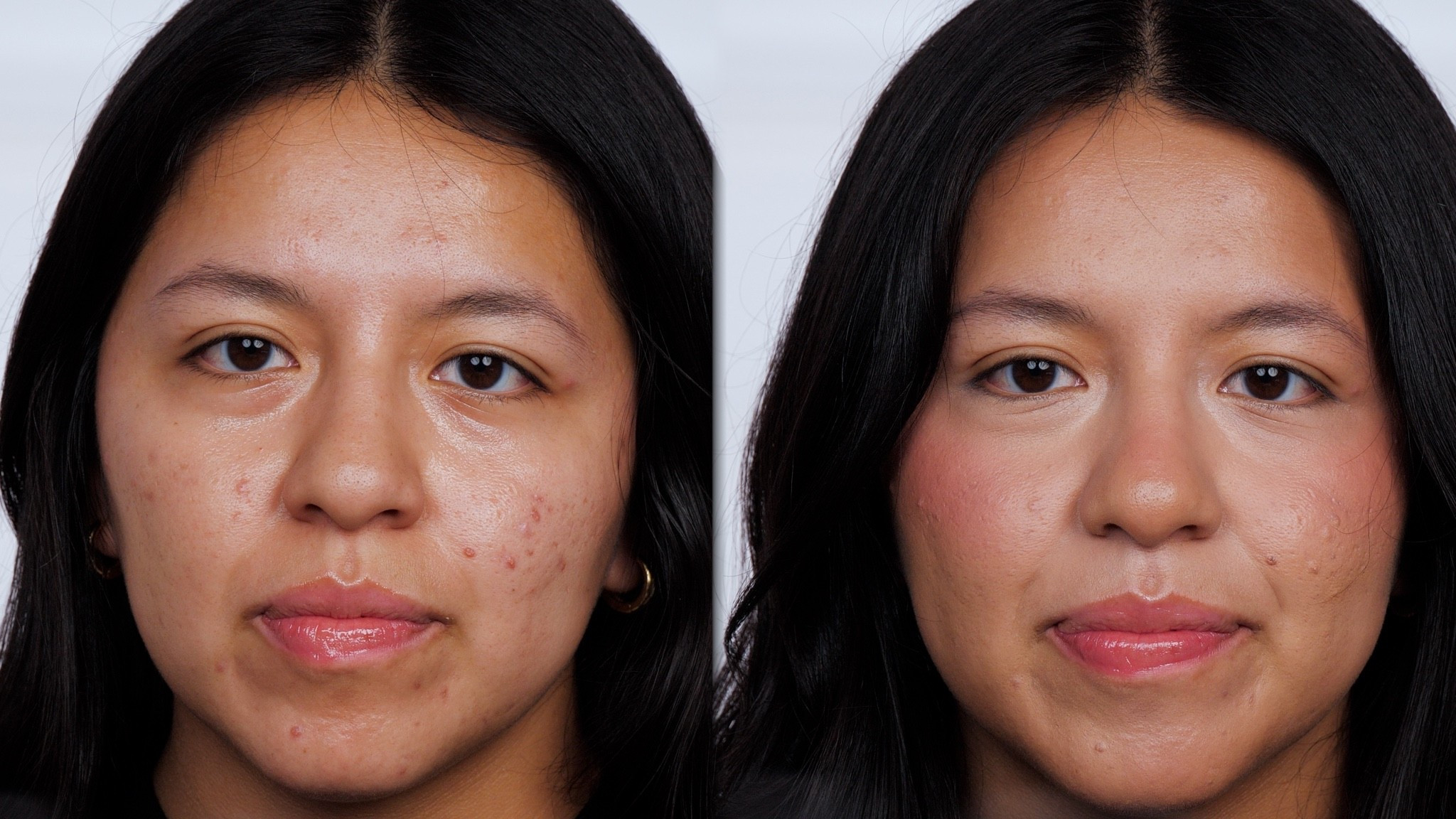 How to cover acne now live on Makeup By Kelli Anne