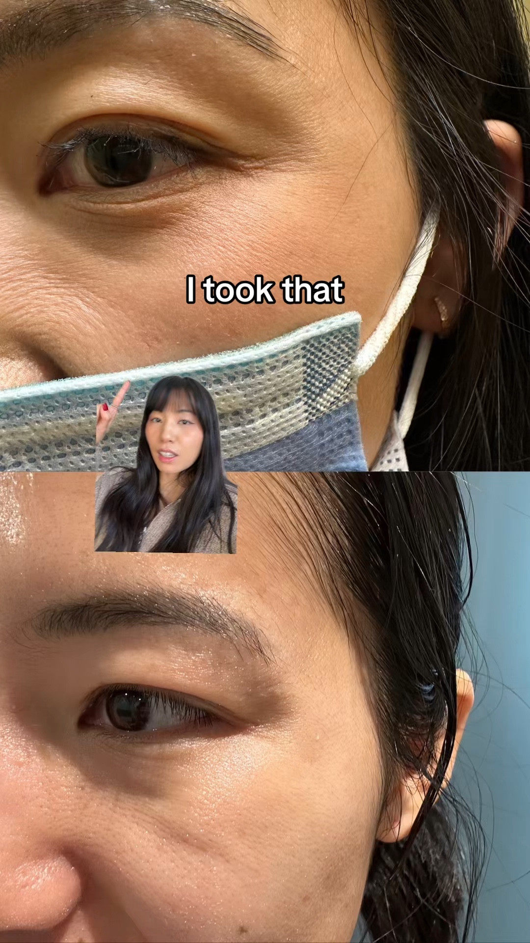 How I faded crow’s feet and fine lines around my eyes! 