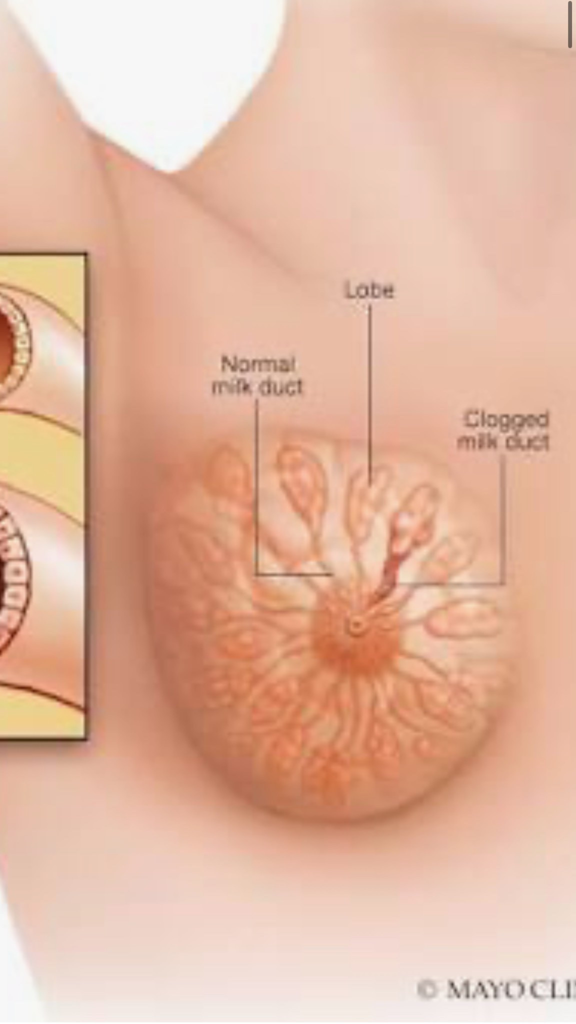 All you need to help with a clogged milk duct or mastitis 

#LTKBaby #LTKFamily
