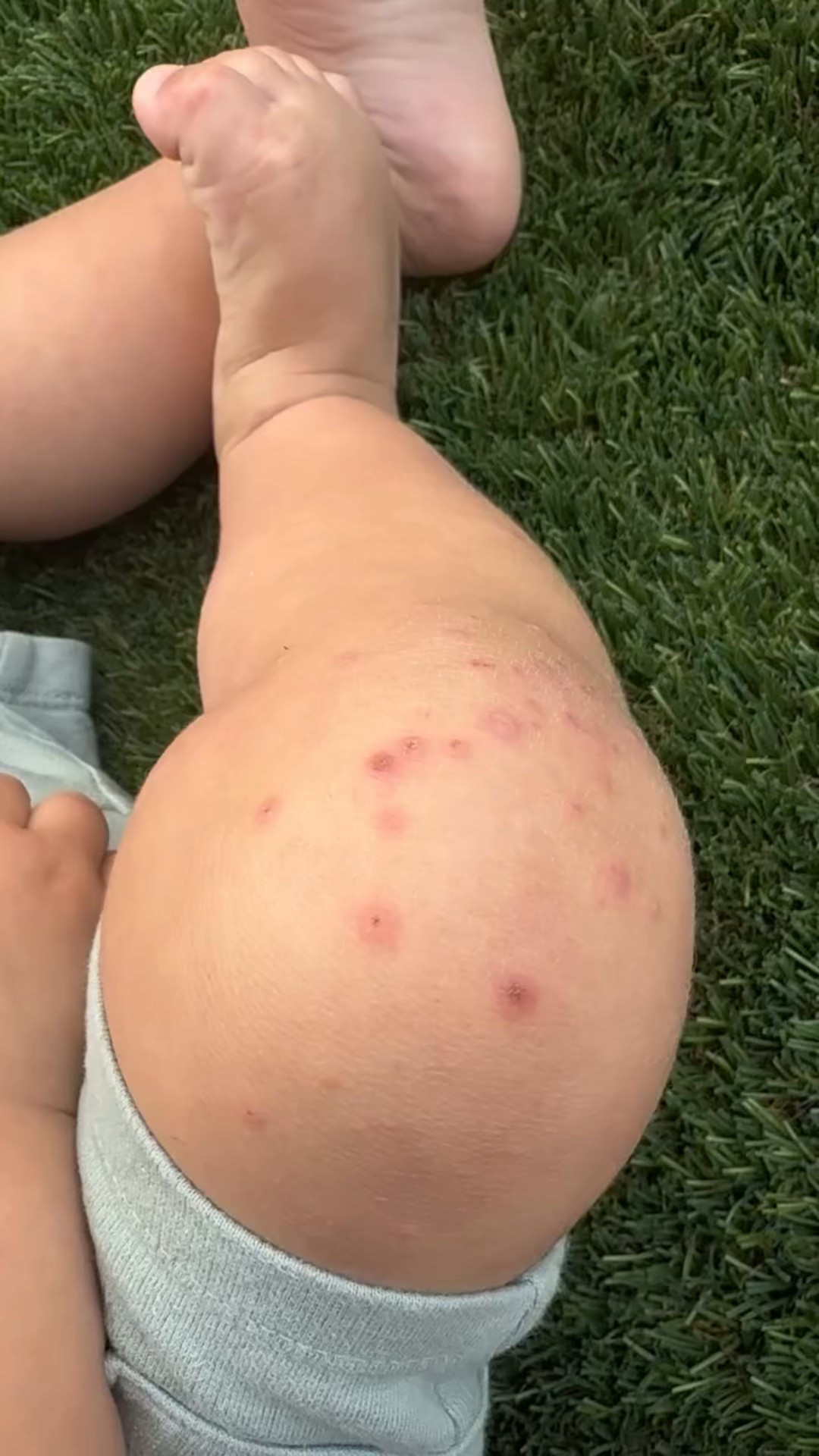 💥 ¿Sabías que el virus de manos, pies y boca no solo afecta a los bebés? 💥

Este virus, causado comúnmente por el Coxsackievirus A16, es súper contagioso y se transmite por contacto directo con la saliva, mocos, heces o superficies contaminadas. 😷 Afecta mayormente a niños menores de 5 años, pero papá y mamá también pueden contagiarse, sobre todo si el sistema inmune está bajito o hay contacto constante con fluidos (¡lo que con un bebé es casi inevitable!).

👨‍👩‍👦 Los adultos pueden presentar síntomas más leves o incluso ningún síntoma, pero aún así pueden contagiar a otros. Por eso, es clave reforzar la higiene y desinfectar todo lo que el bebé toque (especialmente juguetes, cucharas y superficies).

💡 Cuando a Massimo le dio, estos dos productos me ayudaron muchísimo con el picor y la irritación:

1️⃣ Aveeno Eczema Therapy Nighttime Itch Relief Balm: ¡santo remedio para calmarle la comezón en la noche! 💤
2️⃣ Soothing Bath Treatment con avena coloidal 100% natural: le dio alivio inmediato en los brotes durante el baño 🛁✨

🧼 Tip extra: lávate las manos con frecuencia, lava su ropita aparte y evita besarlo en boca o carita si estás en contacto directo con el virus.

💛 Espero que esta info te ayude tanto como a mí. Si estás pasando por esto, ¡ánimo, mamá! No dura para siempre.

#baby #tipsdemama #aveenobaby #aveeno #cuidadodelbebé #momlife #parentingtips #fy #parenthood #mama #fyp #instababy
