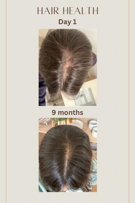 My hair growth journey.  I might just be Nutrafol’s number one fan. 😉 Six pregnancies really took a toll on my hair.  Here are my day one vs month 9 results! I was even shocked. 


#LTKbeauty #LTKbump #LTKfamily